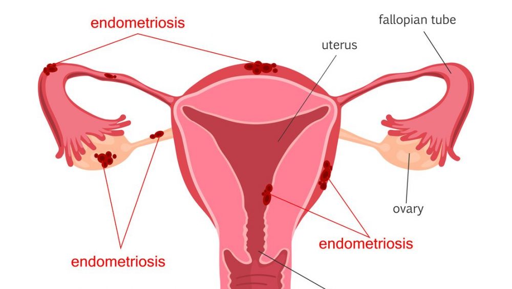 fakta endometriosis